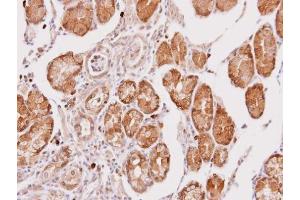 IHC-P Image Immunohistochemical analysis of paraffin-embedded human gastric cancer, using Cathepsin O, antibody at 1:100 dilution. (CTSO Antikörper)