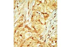 Formalin-fixed and paraffin-embedded human cancer tissue reacted with the primary antibody, which was peroxidase-conjugated to the secondary antibody, followed by DAB staining. (RAGE Antikörper  (C-Term))