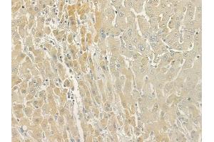 ABIN6266258 and ABIN6277419 at 1/100 staining human hepatocellular carcinoma by IHC-P.