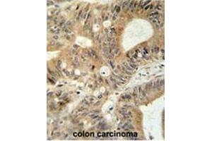 ABCC3 antibody (Center) immunohistochemistry analysis in formalin fixed and paraffin embedded human colon carcinoma followed by peroxidase conjugation of the secondary antibody and DAB staining. (ABCC3 Antikörper  (Middle Region))