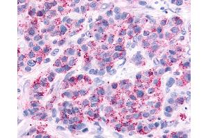Anti-AVPR2 / V2R antibody IHC of human Breast, Carcinoma. (AVPR2 Antikörper  (Cytoplasmic Domain))