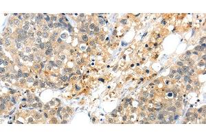 Immunohistochemistry of paraffin-embedded Human liver cancer tissue using KCNG3 Polyclonal Antibody at dilution 1:40 (KCNG3 Antikörper)