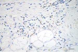 Immunohistochemistry was performed on paraffin-embedded human sigmoid colon carcinoma using ADAM17 antibody (ABIN7797502), 1:200). (Rekombinanter ADAM17 Antikörper)