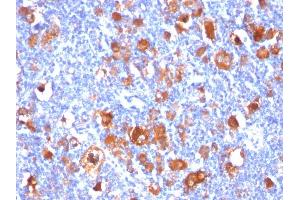Formalin-fixed, paraffin-embedded human Hodgkin's Lymphoma stained with Fascin-1 Mouse Monoclonal Antibody (FSCN1/418). (Fascin Antikörper)