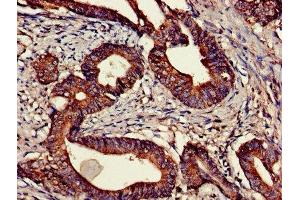 Immunohistochemistry of paraffin-embedded human colon cancer using ABIN7147780 at dilution of 1:100 (CNTF Receptor alpha Antikörper  (AA 106-342))