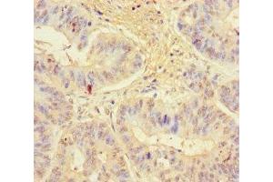 Immunohistochemistry of paraffin-embedded human colon cancer using ABIN7157538 at dilution of 1:100 (KLRG1 Antikörper  (AA 60-195))