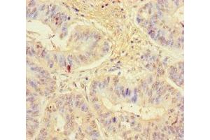 Immunohistochemistry of paraffin-embedded human colon cancer using ABIN7157538 at dilution of 1:100