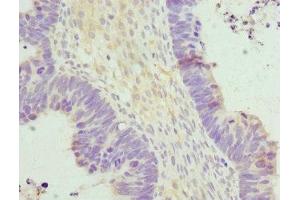 Immunohistochemistry of paraffin-embedded human ovarian cancer using ABIN7155889 at dilution of 1:100 (HERPUD1 Antikörper  (AA 1-240))