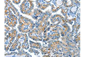 The image on the left is immunohistochemistry of paraffin-embedded Human thyroid cancer tissue using ABIN7190321(COG1 Antibody) at dilution 1/60, on the right is treated with synthetic peptide.