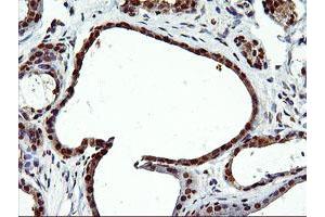 Immunohistochemical staining of paraffin-embedded Human breast tissue using anti-EPM2AIP1 mouse monoclonal antibody. (EPM2AIP1 Antikörper)