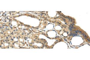Immunohistochemistry of paraffin-embedded Human thyroid cancer using ISM2 Polyclonal Antibody at dilution of 1/45