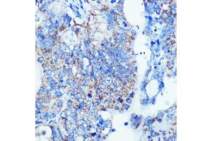 Immunohistochemistry of paraffin-embedded human colon carcinoma using MMP13 Rabbit mAb (ABIN7268419) at dilution of 1:100 (40x lens). (MMP13 Antikörper)