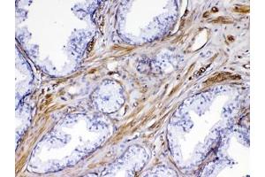 IHC testing of FFPE human prostate cancer tissue with VEGF Receptor 3 antibody at 1ug/ml. (FLT4 Antikörper)