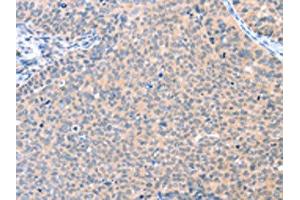 The image on the left is immunohistochemistry of paraffin-embedded Human cervical cancer tissue using ABIN7128109(AADACL2 Antibody) at dilution 1/25, on the right is treated with fusion protein. (AADACL2 Antikörper)