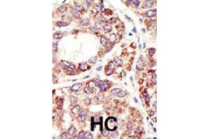 Formalin-fixed and paraffin-embedded human hepatocellular carcinoma tissue reacted with MDM2 polyclonal antibody  , which was peroxidase-conjugated to the secondary antibody, followed by DAB staining. (MDM2 Antikörper  (C-Term))