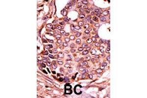 Formalin-fixed and paraffin-embedded human cancer tissue reacted with the primary antibody, which was peroxidase-conjugated to the secondary antibody, followed by DAB staining. (SEPSH2 Antikörper  (AA 171-201))