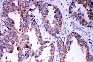 Anti- DISC1 antibody,  IHC(P) IHC(P): Human Lung Cancer Tissue (DISC1 Antikörper  (N-Term))