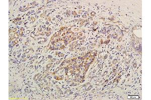 Formalin-fixed and paraffin embedded human pancreatic cancer labeled with Anti-EDG7/LPA3 Polyclonal Antibody, Unconjugated (ABIN681133) at 1:400 followed by conjugation to the secondary antibody and DAB staining (LPAR3 Antikörper  (AA 101-200))