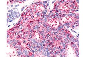 Anti-HNF4G / HNF4 Gamma antibody IHC of human Breast, Carcinoma. (HNF4 gamma Antikörper  (Internal Region))