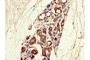 IHC image of ABIN7159059 diluted at 1:300 and staining in paraffin-embedded human breast cancer performed on a Leica BondTM system. (MGP Antikörper  (AA 20-96))