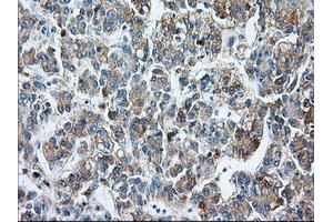 Immunohistochemical staining of paraffin-embedded Carcinoma of liver tissue using anti-BSG mouse monoclonal antibody. (CD147 Antikörper)