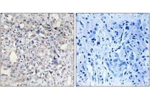 Immunohistochemistry analysis of paraffin-embedded human liver carcinoma tissue, using Heparin Cofactor II Antibody. (SERPIND1 Antikörper  (AA 41-90))