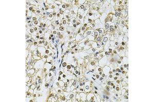 Immunohistochemistry of paraffin-embedded human kidney cancer using IFI16 Antibody (ABIN6129036, ABIN6142162, ABIN6142163 and ABIN6218202) at dilution of 1:100 (40x lens). (IFI16 Antikörper  (AA 1-300))