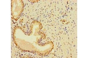 Immunohistochemistry of paraffin-embedded human prostate cancer using ABIN7166969 at dilution of 1:100 (RABEP2 Antikörper  (AA 301-533))