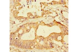 Immunohistochemistry of paraffin-embedded human colon cancer using ABIN7153335 at dilution of 1:100 (GPR183 Antikörper  (AA 1-31))