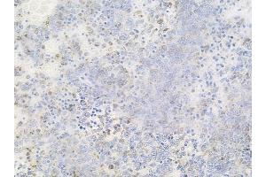 ABIN6256556 and ABIN6267493 at 1/100 staining human melanoma by IHC-P. (MEK2 Antikörper  (pThr394))