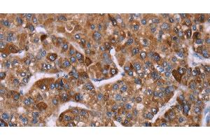 Immunohistochemistry of paraffin-embedded Human liver cancer tissue using HSP10 Polyclonal Antibody at dilution 1:40 (HSPE1 Antikörper)