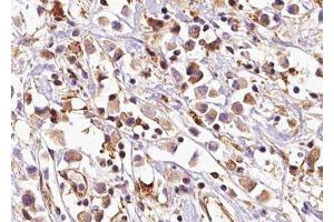 ABIN6279152 at 1/100 staining Human breast cancer tissue by IHC-P. (ATP5E Antikörper  (Internal Region))