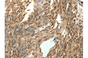 The image on the left is immunohistochemistry of paraffin-embedded Human ovarian cancer tissue using ABIN7131276(SYT7 Antibody) at dilution 1/15, on the right is treated with fusion protein.