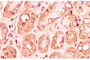 Human stomach cancer tissue was stained by rabbit Anti-Spexin prepro (73-116)  (H) Antibody (Spexin Antikörper  (Preproprotein))