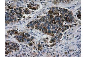 Immunohistochemical staining of paraffin-embedded Carcinoma of Human lung tissue using anti-LGALS3BP mouse monoclonal antibody. (LGALS3BP Antikörper  (AA 19-300))