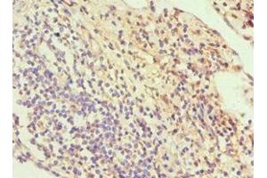 Immunohistochemistry of paraffin-embedded human cervical cancer using ABIN7170114 at dilution of 1:100 (GLUT1 Antikörper  (AA 210-310))