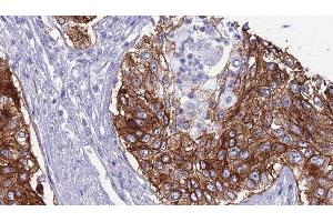 ABIN6276794 at 1/100 staining Human urothelial cancer tissue by IHC-P. (CD46 Antikörper  (N-Term))