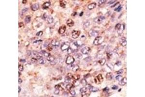 IHC analysis of FFPE human hepatocarcinoma tissue stained with the ABCB7 antibody (ABCB7 Antikörper  (AA 718-746))