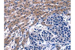 The image on the left is immunohistochemistry of paraffin-embedded Human liver cancer tissue using ABIN7129604(GIP Antibody) at dilution 1/13, on the right is treated with fusion protein. (GIP Antikörper)