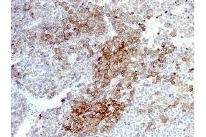 Formalin-fixed, paraffin-embedded human Melanoma stained with NGFR Monoclonal Antibody (NGFR5 + NTR/912). (NGFR Antikörper)