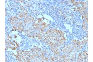 Formalin-fixed, paraffin-embedded human GIST stained with CD117 Mouse Monoclonal Antibody (C117/370). (KIT Antikörper)