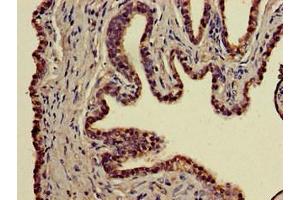 Immunohistochemistry of paraffin-embedded human prostate cancer using ABIN7155629 at dilution of 1:100 (BBX Antikörper  (AA 62-292))