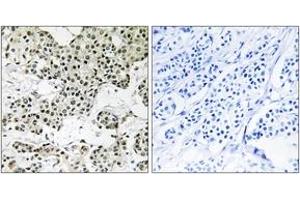Immunohistochemistry analysis of paraffin-embedded human breast carcinoma tissue, using THOC5 Antibody.