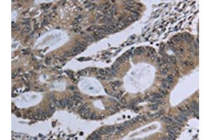 The image on the left is immunohistochemistry of paraffin-embedded Human colon cancer tissue using ABIN7129632(GNG2 Antibody) at dilution 1/60, on the right is treated with fusion protein. (GNG2 Antikörper)