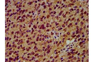 IHC image of ABIN7151218 diluted at 1:600 and staining in paraffin-embedded human glioma performed on a Leica BondTM system.