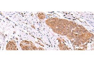 Immunohistochemistry of paraffin-embedded Human esophagus cancer tissue using ASTN2 Polyclonal Antibody at dilution of 1:80(x200) (Astrotactin 2 Antikörper)