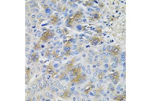 Immunohistochemistry of paraffin-embedded human liver cancer using SERPINA1 antibody.