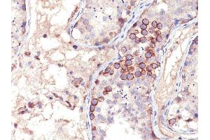 Immunohistochemistry (IHC) image for anti-Melanoma Antigen Family A, 1 (Directs Expression of Antigen MZ2-E) (MAGEA1) antibody (ABIN6940000)