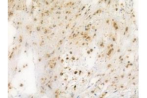 ABIN6261409 and ABIN6269309 at 1/100 staining human breast carcinoma by IHC-P. (E2F1 Antikörper  (C-Term))
