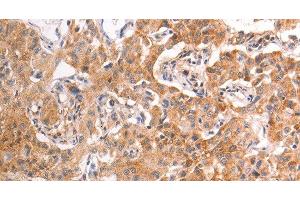 Immunohistochemistry of paraffin-embedded Human liver cancer tissue using TRPV4 Polyclonal Antibody at dilution 1:40 (TRPV4 Antikörper)